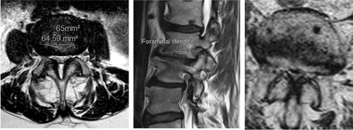 Figure 3. Lateral recess stenosis (left), foraminal stenosis (center) and central spinal stenosis (right).