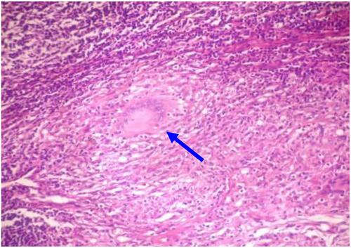 Figure 1 Histopathology of genitourinary tuberculosis showing extensive caseous tissue with occasional granulomas composed of epithelioid cells and Langhans giant cells with surrounding lymphocytes (indicated by blue arrow).