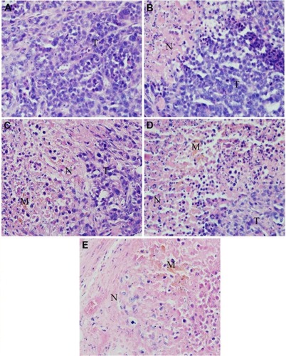 Figure 7 Histopathological changes in NPC xenograft tumors (stained with hematoxylin-eosin, 40×).Notes: (A) Negative control group. (B) DOX-BSA NP group. Inflammation can be observed in the tissues. (C) BSA MNP group with heating. A large amount of inflammatory cell infiltration and some spotty necrosis were noted. Brown magnetic materials were deposited in the tissue. (D) DOX-BSA MNP group with heating. Similar to (C), brown magnetic materials, inflammatory cell infiltration, and spotty necrosis are seen in the tissue and cells, albeit to a greater degree. (E) FA-DOX-BSA MNP group with heating. The effect in this group was the most different compared with the other groups. Massive necrosis with marked cell disintegration is evident throughout the image.Abbreviations: T, tumor tissue; N, necrosis; M, materials of Fe3O4; FA, folic acid; DOX, doxorubicin; BSA, bovine serum albumin; MNP, magnetic nanoparticles; NP, nanoparticles; NPC, nasopharyngeal carcinoma.