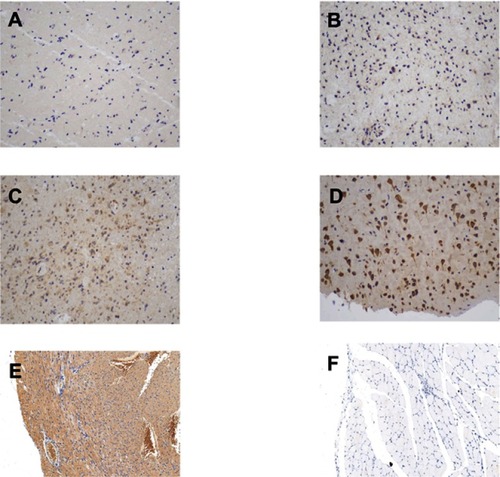 Figure S1 The immunohistochemical staining score of PLA2G5 in glioma and positive/negative control (magnification ×200). (A) Percentage score = 1, intensity score = 1; (B) Percentage score = 2, intensity score = 1; (C) Percentage score = 3, intensity score = 2; (D) Percentage score = 3, intensity score = 3; (E) Positive control: cardiac muscle; (F) Negative control: striated muscle.