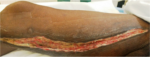 Figure 1 Wound before application of VAC dressing.