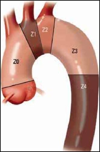 Figure 1. Ishimaru proximal landing zones of the aortic arch. Z indicates landing zone number.