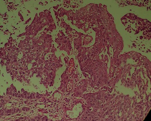 Figure 4 Neoplastic cells with small foci of keratin formation. H&E, 400X.