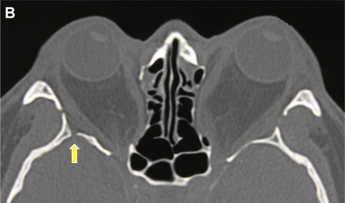 Figure 1B Axial computerized tomography scan of a 34-year-old male patient with Graves’ orbitopathy after bilateral balanced decompression surgery with rim intact approach. The deep lateral area of the trigone was not removed. The yellow arrow indicates the bony defect through which cerebrospinal fluid leakage occurred.