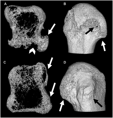 Figure 4. HR-pQCT scan of 2nd metacarpal heads. (A) and (B) - rheumatoid arthritis patient: in (A) axial slice showing close association between osteophyte (white arrow) and erosion (white head arrow); (B) the same bone lesions in a 3D reconstruction, erosion (black arrow) and osteophyte (white arrow) represented. (C) and (D) - psoriatic arthritis patient: (C) axial slice demonstrating enthesiophytes (white arrows) without erosions, and (D) the same bone proliferations (white and black arrows) in a 3D image.