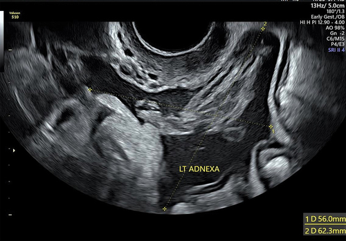 Figure 6. Left adnexa with marked free fluid in the pouch of Douglas.