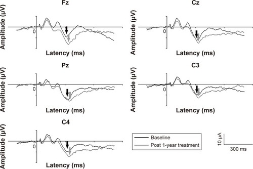 Figure 1 Representative P300 waveforms in patients with obsessive-compulsive disorder.