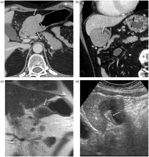 Figure 1. (a) Contrast-enhanced CT (axial image), (b) Contrast-enhanced CT (coronal image), (c) MRI; T2-weighted image (coronal image), and (d) Ultrasonographic image. Contrast-enhanced CT shows well-demarcated mass lesion in the antrum of the stomach (a: arrows). Reflecting the submucosal location of the lesion, gastric mucosa is described as strongly enhanced layer between the gastric lumen and mass lesion (b: arrow). The mass lesion shows homogeneous low intensity in MRI, and spared gastric mucosa is revealed as linear high intensity (c: arrows). In ultrasonography, the mass is described as homogeneous low echoic lesion and normal gastric mucosa is described as high echoic layer (d: arrows).