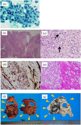 Figure 2. Pathology images. (a) Accumulation of atypical cells with enlarged nuclei, increased amounts of chromatin, and distinct nucleoli with poor binding on aspiration cytology (Papanicolaou staining). (b) Round to polygonal atypical cells with round nuclei and eosinophilic cytoplasm growing in sheet form around vessel (low magnification, hematoxylin & eosin staining). (c) The arrows in the image indicate increased mitotic activity (high magnification, hematoxylin & eosin staining). (d) Tumor cells immunohistochemically positive for smooth muscle actin. (e) Basement membranous material demonstrated by periodic acid-Schiff reaction. (f) Thyroid lesion (largest), forming 8.0 × 5.6 × 3.6-cm mass (yellow arrowheads) in contact with trachea (red arrowheads). (g) White mass which formed (yellow arrowheads) and infiltrated the trachea (red arrowheads).