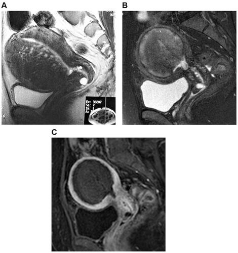 Figure 1 A 43-year-old woman who underwent uterine artery embolization for symptomatic adenomyosis. (A) Sagittal T2-weighted magnetic resonance imaging obtained before uterine artery embolization shows diffuse junctional zone thickening of the uterus, especially in the anterior wall. The volume of the uterus was 608 cm3. (B) Sagittal T2-weighted magnetic resonance imaging obtained three months after uterine artery embolization shows the decreased size of the adenomyosis and the uterus. The volume of the uterus was 212 cm3. (C) Sagittal contrast-enhanced T1-weighted magnetic resonance imaging obtained three months after uterine artery embolization shows that the adenomyosis was almost completely necrotic.