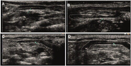 Figure 3. Representative Two-dimensional ultrasound images of rat uterus, (A) sham group, (B) vehicle-treated group (IUAgroup), (C) KGF solution-treated group, and (D) KGF-HP hydrogel-treated group.