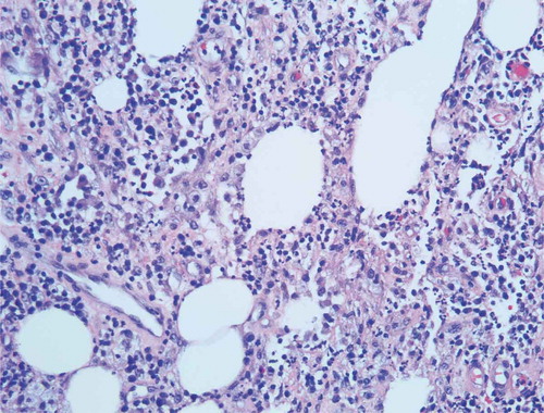 Picture 6. Inflammatory infiltrate extending into subcutaneous tissue with neutrophils, lymphocytes, plasma cells and histiocytes