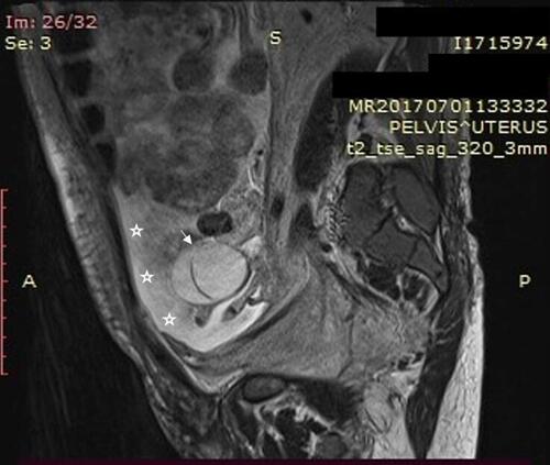 Figure 2 Sagittal T2-weighted MRI without injection showing bilobular ovarian mass (arrow) and ascites (asterisk).