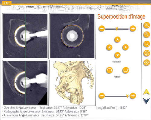 Figure 2. Screen view of the software interface used to determine the cup orientation on post-operative CT. The final position is displayed and recorded. [Color version available online.]