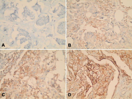 Figure 1 Immunohistochemistry staining for PD-L1 in breast cancer tissues.