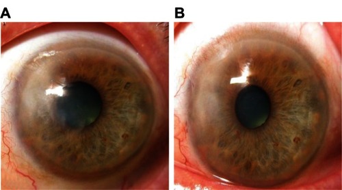 Figure 2 Appearance of case 3 (A) before and (B) six months after surgery.