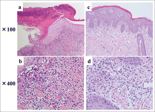Figure 2. Histopathological finding of skin biopsy from patients 1 (H & E; a: × 100, b: × 400) and 2 (H & E; c: × 100, d: × 400).