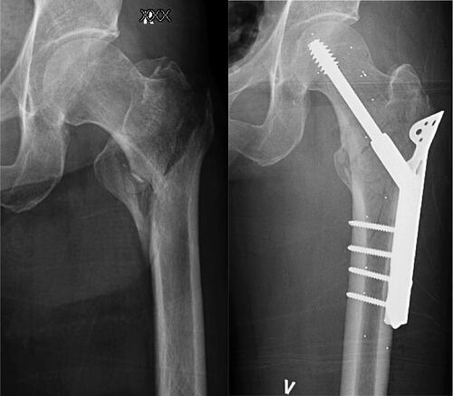 Figure 1. Pre- and postoperative images of a AO/OTA 31-A2 fracture operated on with a sliding hip screw with trochanteric stabilizing plate (TSP). The TSP should prevent excessive medialization of the femoral shaft by buttressing the lateral trochanteric wall. In this case, a loss of medial buttress with a large lesser trochanter fragment and a thin lateral wall would strengthen the traditional indication for a TSP.
