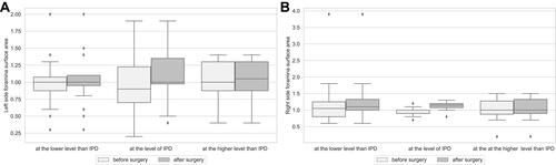 Figure 3 (A) Median surface area of the left intervertebral foramen on the operated and adjacent levels before and after surgery. (B) Median surface area of the right intervertebral foramen on the operated and adjacent levels before and after surgery.