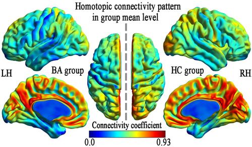 Figure 1 VMHC spatial patterns at the group mean level of the BA and HC groups.