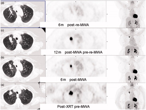 Figure 4. A 56-year-old patient with right upper lobe (RUL) non-small cell lung cancer (NSCLC) with FDG-PET scan series. (a) After 30 cycles x 2 Gy of radical external beam radiotherapy. (b) Six months after MWA shows residual inferior FDG uptake, best appreciated on the coronal MIP. (c) welve months after MWA shows enlarging RUL mass with increasing FDG uptake. (d) Six months after re-MWA shows shrinking focus with no residual FDG uptake.