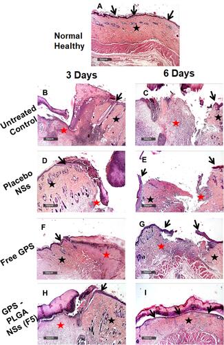 Figure 12 Wound healing process at day 3 and day 6-time interval in different groups. (A) Normal healthy, (B and C) Untreated Control, (D and E) Placebo NSs, (F and G) Free GPS, and (H and I) GPS - PLGA NSs (F5). H&E stain 40X. Arrow = Epidermal layer. Black star = Dermal layer, Red star = Wound gab granulation tissue.