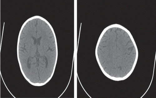 Figure 2. Essentially normal CT scan of the same patient after 4 weeks of treatment.