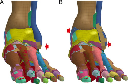 Figure 5. Ankle fractures formed by lateral-medial (L-M) impacts on the ankle. (A) Impacts at lower speeds (10 or 15 m/s) cause lateral condyle fractures. (B) Impacts at higher speeds (≥20 m/s) cause lateral condyle fractures and avulsion fractures of the medial condyle. (Red arrow indicates the fracture site where elements are coloured differently from the surrounding area).