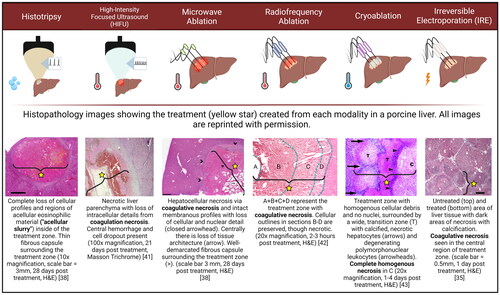 Figure 1. Histopathologic comparison of tissue destruction modalities. Differences in procedural application and mechanism of action between histotripsy, high intensity focused ultrasound (HIFU), microwave ablation (MW), radiofrequency ablation (RF), cryoablation, and irreversible electroporation (IRE) are illustrated in the pictograms under each modality. Histotripsy uses cavitation to mechanically destroy tissue. HIFU, MW, RF and cryoablation use thermal mechanisms to create coagulative necrosis and IRE uses electricity to disrupt the cell membrane potential. Pathologic differences are illustrated below each modality. Images have been reprinted with permission and license numbers can be found in the Acknowledgements section.
