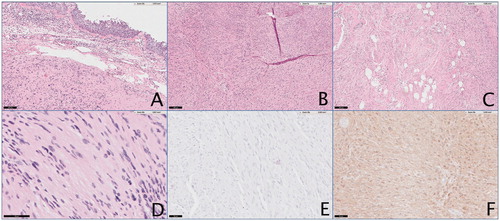 Figure 4. Pathology analysis of nasal mass using multiple stains to delineate nasal schwannoma. (A) 10×, view of nasal mass with nasal mucosa stained with hematoxylin/eosin. (B) 5× view identifying Antoni A areas. (C) 5× view identifying Antoni B areas. (D) 5× view showing Verocay bodies. (E) 20× view showing strong staining for Ki-67. (F) 20× view staining positively for S-100.