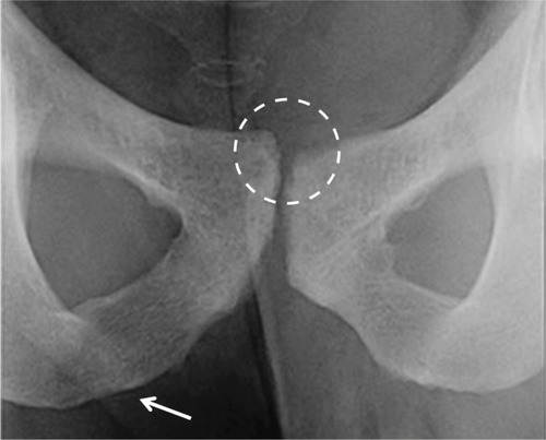 Figure 2 “Flamingo view” radiograph (obtained with the patient bearing weight alternately on each leg) that shows vertical pubic subluxation greater than 2 mm and underlying degenerative changes.