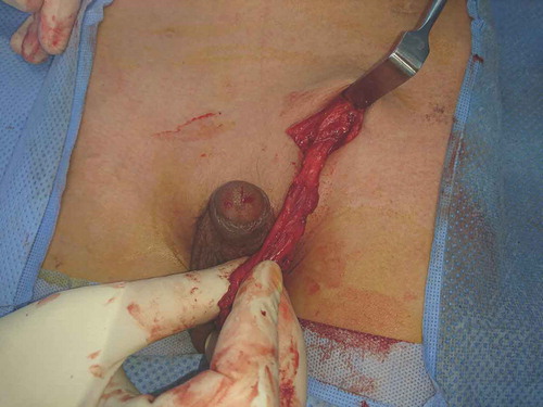Figure 3. Testis reaching the scrotum easily from outside.