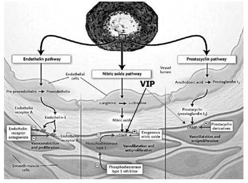 Figure 1 Consequences of endothelial dysfunction on pulmonary vascular smooth muscle showing potential targets for therapy. Three major pathways and associated therapeutic targets in abnormal proliferation and contraction of smooth muscle cells are shown. Dysfunctional endothelial cells have decreased production of prostacyclin and endogenous nitric oxide and increased production of endothelin-1. This imbalance of mediators along with decreased production of vasoactive intestinal peptide (VIP) results in a condition favouring vasoconstriction and proliferation of pulmonary artery smooth muscle cells. In addition to their actions on smooth muscle, these mediators have other properties including antiplatelet effects of nitric oxide and prostacyclin and profibrotic and proinflammatory effects of endothelin. Plus signs denote an increase in intracellular concentration: minus signs reflect blockage of a receptor, inhibition of an enzyme or a decrease in the intracellular concentration. (Modified and published with permission from CitationHumbert, Sitbon et al (2004)).Abbreviations: cGMP cyclic guanosine monophosphate; cAMP, cyclic adenosine monophosphate.