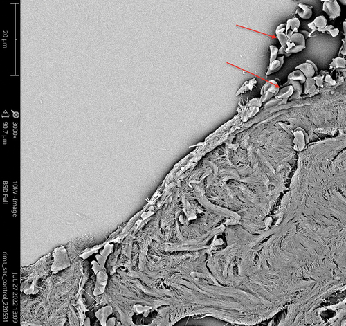 Figure 3. Sample from the lacrimal sac of the control patient. Neither bacteria nor biofilm were found. Red blood cells resulting from the surgery can be seen on the luminal part of the sac.