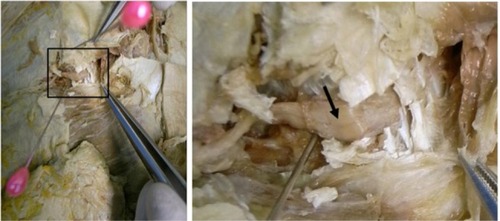 Figure 3 Photographs (overview of pelvis, left and close view, right) showing entrapment of the MCN under the LPSL obtained from an 85-year-old woman (specimen no. 7).