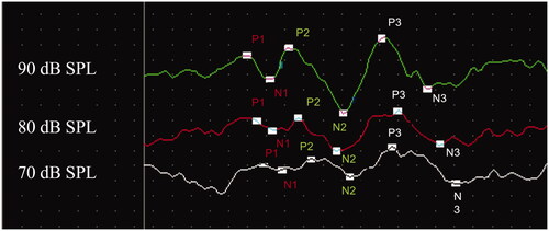 Figure 1. Example of cursored ABR waveform. Representative example of a 16 kHz ABR waveform that was cursored for amplitude and latency analysis. Cursors appear at positive P1, P2, and P3 peaks, and the negative troughs that followed.