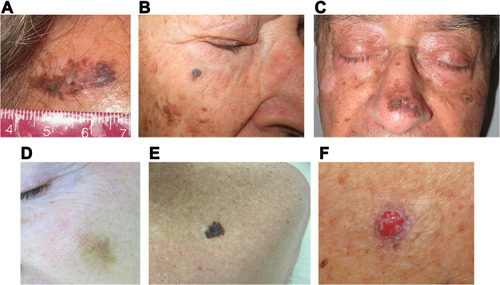 Figure 1 Lentigo maligna(LM)/LM melanoma (LMM) clinical presentations. (A) LM presenting as a large irregularly pigmented patch in the forehead with central regression and ill-defined borders. (B) LM arising on the right cheek clinically simulating a seborrheic keratosis. (C) Large LM occurring on the nose and surrounded by chronically sun damaged skin. (D) Light brown patch with ill-defined borders in a fair-skinned individual corresponding to a LMM that can clinically be easily mistaken for solar lentigo. (E) Extrafacial LMM affecting the upper back presenting as an isolated large homogeneous brown patch with irregular borders. (F) Nodular melanoma arising on a previous LM (note the brown pigment surrounding the nodule corresponding to the in situ component).