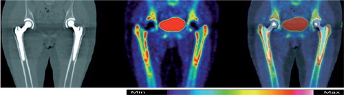 Figure 2. From left to right: CT-, F-PET-, and combined PET/CT-images of pelvis and hips 4 months after surgery. BetaCone stem in the right hip and SL-PLUS in the left hip. Blue color indicates low activity and white color indicates high activity.