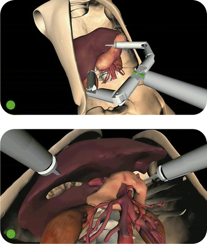 Figure 3. The Computer Guidance Module during a simulated cholecystectomy, working in PASSIVE modality. The surgeon can switch between different viewing modalities, e.g., using the panoramic view mode (top) or the same robot stereoscopic camera placed between the two robotic arms (bottom).