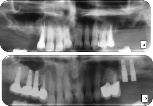 Figure 1. Panoramic radiographs of the representative case: before sinus augmentation (a) and after sinus augmentation and implant placement (b).