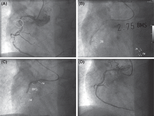 Figure 2. A. LAO view: severe multifocal right coronary artery disease, the artery being very calcified and tortuous. The distal lesion was the most severe. B. Jailing the buddy wire during distal stenting. Note the actual shape of the 5F guide catheter in a ‘power position’. C. More proximal stent positioning over the jailed wire (JW), the free wire has been pulled back (FW). D. Final result.