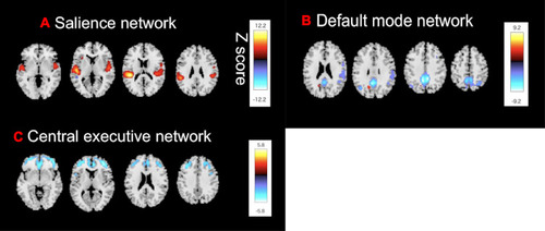 Figure 1 Source-based morphometry reveals (A) The SN, (B) The CE network, and (C) The DM network. Shown are the structural covariance networks with |Z| > 2.5. Red/yellow colors correspond to regions in which the voxel volumes show a positive correlation, while blue/light-blue colors correspond to regions in which the voxel volumes show a negative correlation.