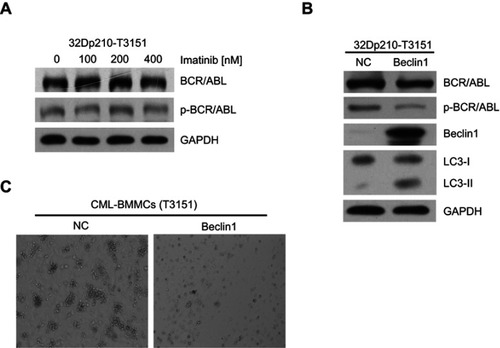 Figure 4 Beclin1 overexpression in T315I mutant CML cells induces BCR/ABL downregulation and promotes autophagic cell death. (A) 32Dp210-T315I cells were cultured with different imatinib concentrations for 24 h, and the expression and activation of BCR/ABL protein were assessed via Western blotting. (B) Western blot analysis of BCR/ABL, p-BCR/ABL, Beclin1 and LC3-I/II levels in Beclin1-overexpressing or negative control 32Dp210-T315I cells. (C) CFC assays were performed with BMMCs derived from CML-BC patients with T315I mutant BCR/ABL. The primary cells were infected with LV-Beclin1 or LV-NC. After 14 days of culture in methylcellulose medium, GM-CFUs were observed. All experiments were repeated at least three times.Abbreviations: BMMCs, bone marrow mononuclear cells; NC, negative control; GM-CFUs, granulocyte-macrophage colony-forming units.