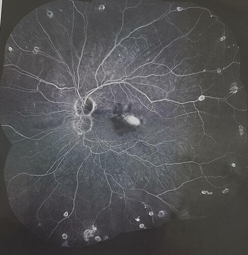 Figure 5 Active CNV in a patient with Vogt–Koyanagi–Harada syndrome.