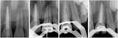 Figure 4. Endodontic treatment of the ULCI.
