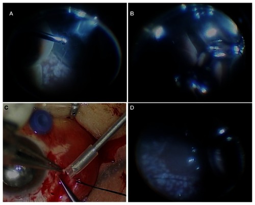 Figure 2 Intraoperative findings of the second vitrectomy. (A) Huge choroidal detachment and (B) “kissing retina” were observed. (C) Fundus photography showed the suprachoroidal hemorrhage removal through the sclerotomy site. (D) At the end of the vitrectomy, fundus photography showed a flat posterior pole and peripheral retina.