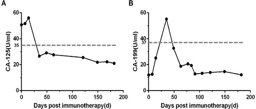 Figure 4 Dynamic change curves of tumor markers in peripheral blood during immunotherapy. (A) The curves of CA-125 (carbohydrate antigen-125) showed that an increase in the related quantity at the beginning of immunotherapy, followed by a gradual decrease. (B) The curves of CA-199 (carbohydrate antigen-199) were similar to A. First of all, the gray dashed line represented the normal range in detail. The normal range of tumor markers was below the dashed line. More intuitively, tumor markers had fallen from high to low levels and had remained low, a phenomenon that reflected the effectiveness of combination therapy. In addition, the definition of the normal range is based on our hospital testing methods. Next, if the evaluation of the treatment effect is CR (complete response), the tumor markers are required to continue normally for more than 4 months.