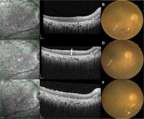 Figure 3 OCT images and fundus photographs of eye 8. (A and B) Before intravitreal methotrexate, OCT revealed outer retina fuzzy borders (arrow) and pigment epithelium detachment (arrow head). Fundus photograph showed retinal vasculitis, retinal hemorrhage (asterisk) and hard exudates (dotted arrow). (C and D) After induction phase, flat pigment epithelium detachment decreased (arrow head) and outer retina fuzzy borders improved (arrow). Retinal hemorrhage was absorbed and hard exudates (dotted arrow) decreased on the fundus photograph. (E and F) After consolidation phase, abnormalities did not improve obviously on the OCT image. On the fundus photograph, hard exudates disappeared. However, several subretinal yellow-white lesions (asterisk) were observed inferior to the optic disc.
