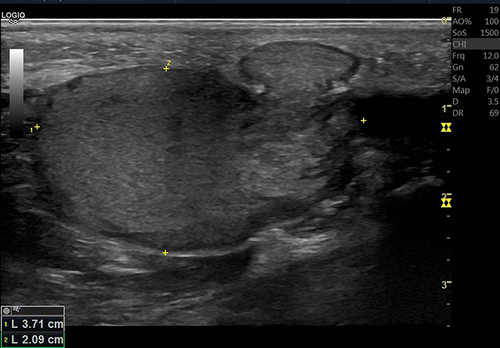 Figure 1 Ultrasound of a 25-year-old woman with a ruptured epidermal inclusion cyst in the left leg shows a well-circumscribed subcutaneous cystic mass with evidence of wall rupture and leakage of turbid content to the surrounding tissue.