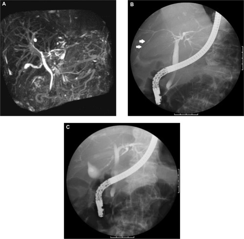 Figure 2 MRCP (A) and ERCP (B and C) revealed narrowed whole intrahepatic bile ducts with smooth walls (white arrows).